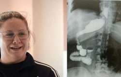 100 binde bir görülüyor: Zayıflamak için masaya attı, doktorlar gördükleri karşısında şoke oldu