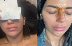 Estetik operasyon hayatını kararttı! Burnunu yaptıran genç kadın ölümden döndü!