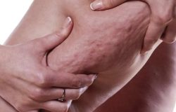 Lipödem nedir? Tedavisi var mı? Lipödem için önlem almak mümkün mü?
